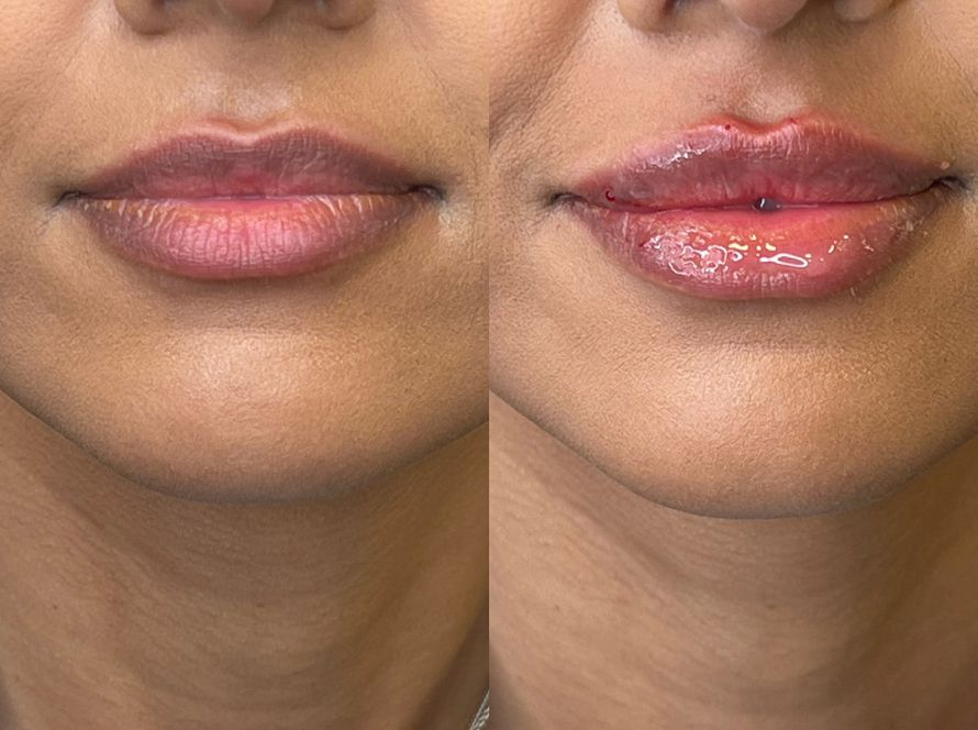 Dermal Filler & Regenerative Treatments at By Narjis