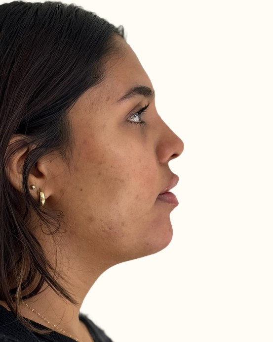Chin & jawline, case 1 of 4: after