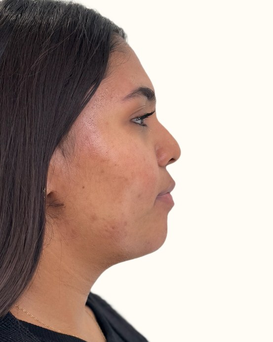 Chin & jawline, case 1 of 4: before