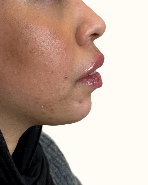 Chin & jawline, case 2 of 4: after
