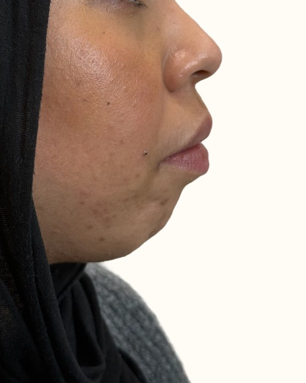 Chin & jawline, case 2 of 4: before