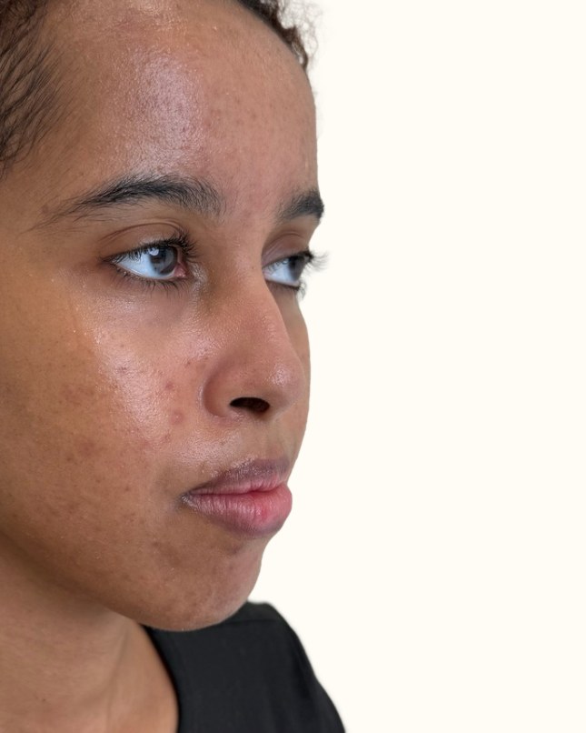 Chin & jawline, case 4 of 4: before
