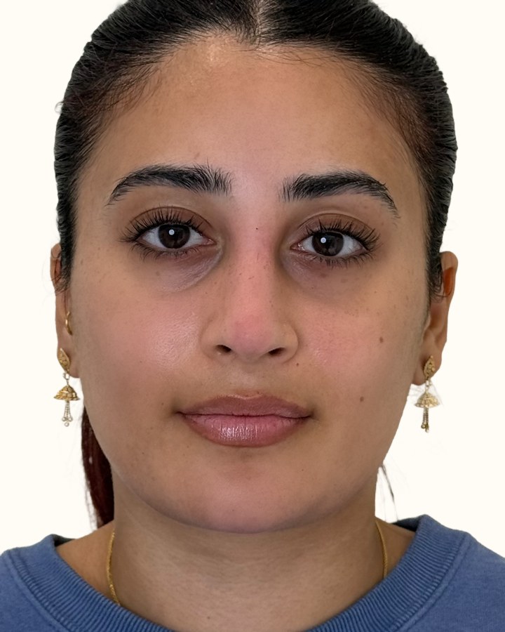 Jaw reduction, case 3 of 4: after