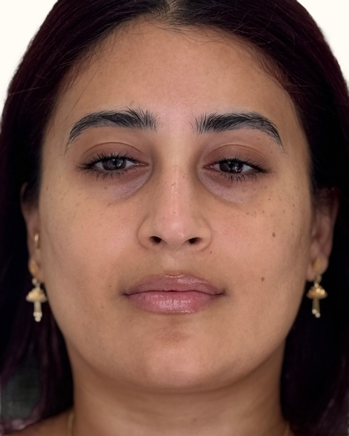 Jaw reduction, case 3 of 4: before