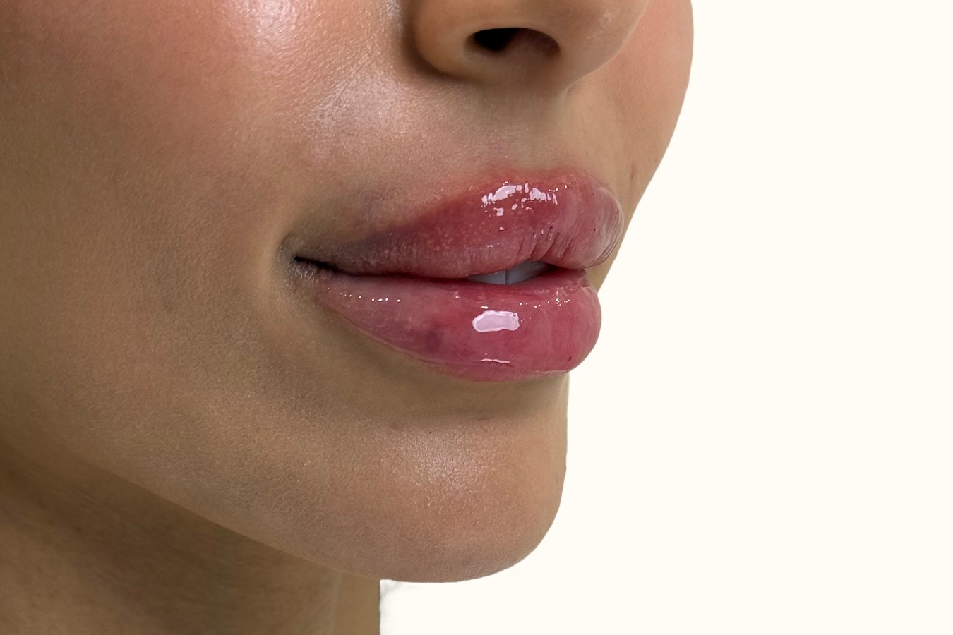 Lip correction, case 1 of 7: after