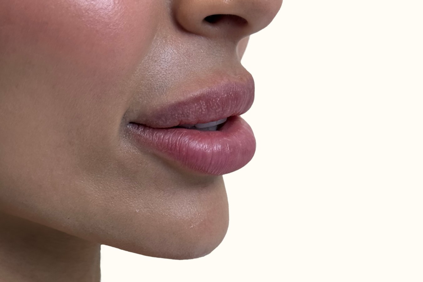 Lip correction, case 1 of 7: before