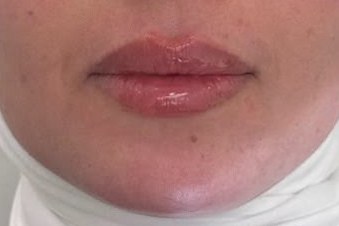 Lip correction, case 3 of 7: after