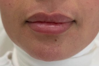 Lip correction, case 3 of 7: before