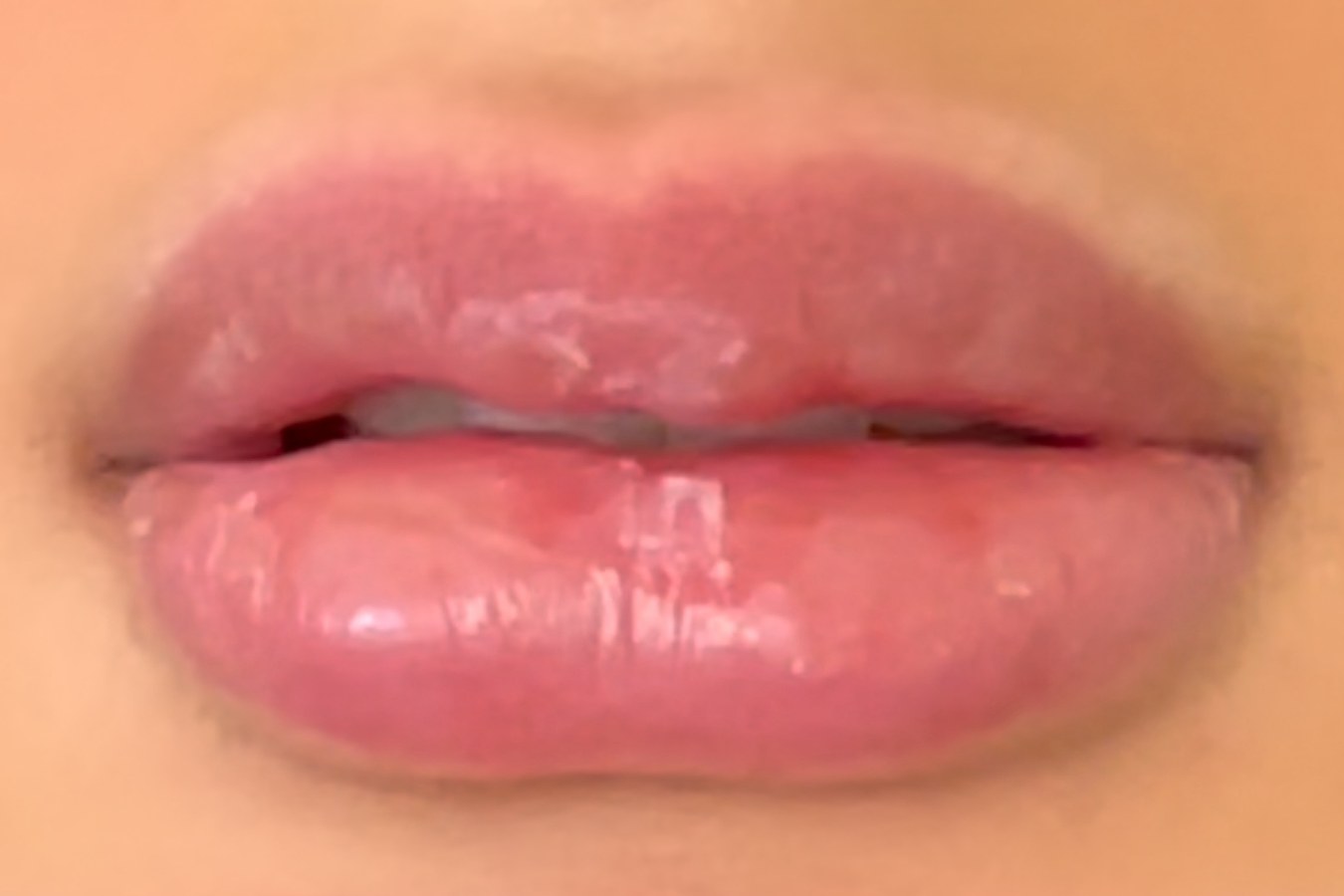 Lip correction, case 5 of 7: before