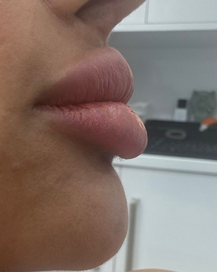 Lip correction, case 6 of 7: before