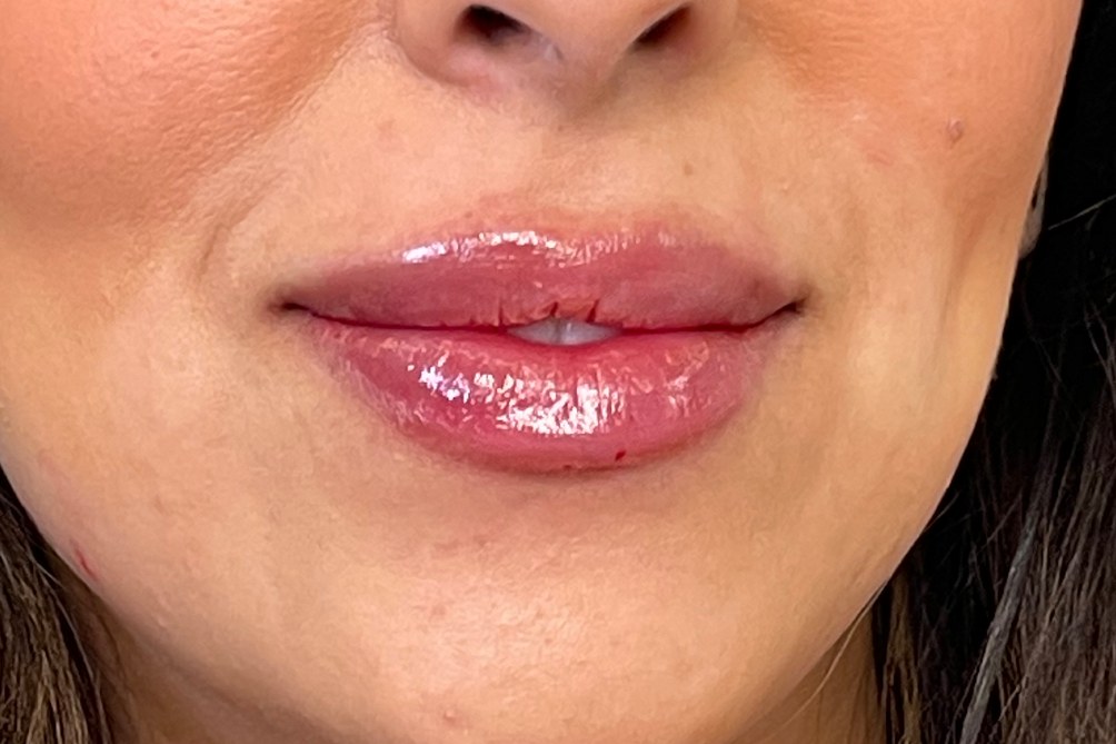 Lip correction, case 7 of 7: after
