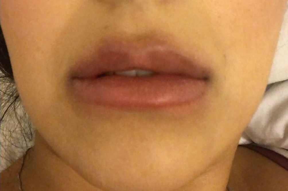 Lip correction, case 7 of 7: before
