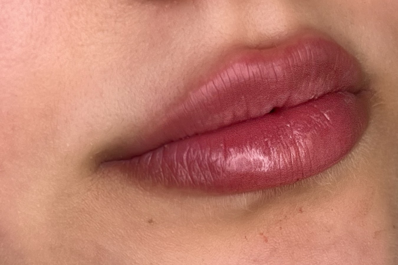 Lips, case 1 of 10: after