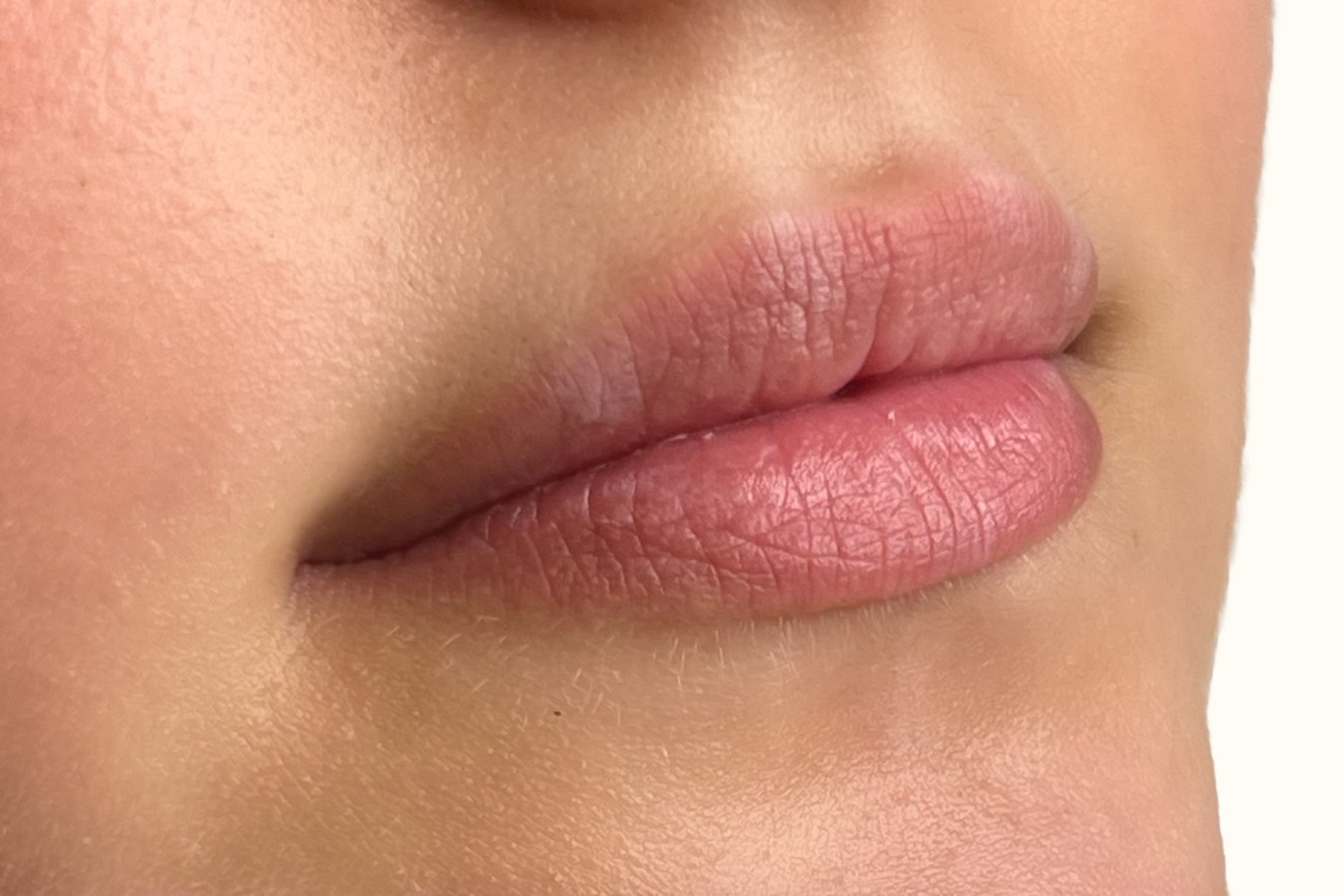 Lips, case 1 of 10: before