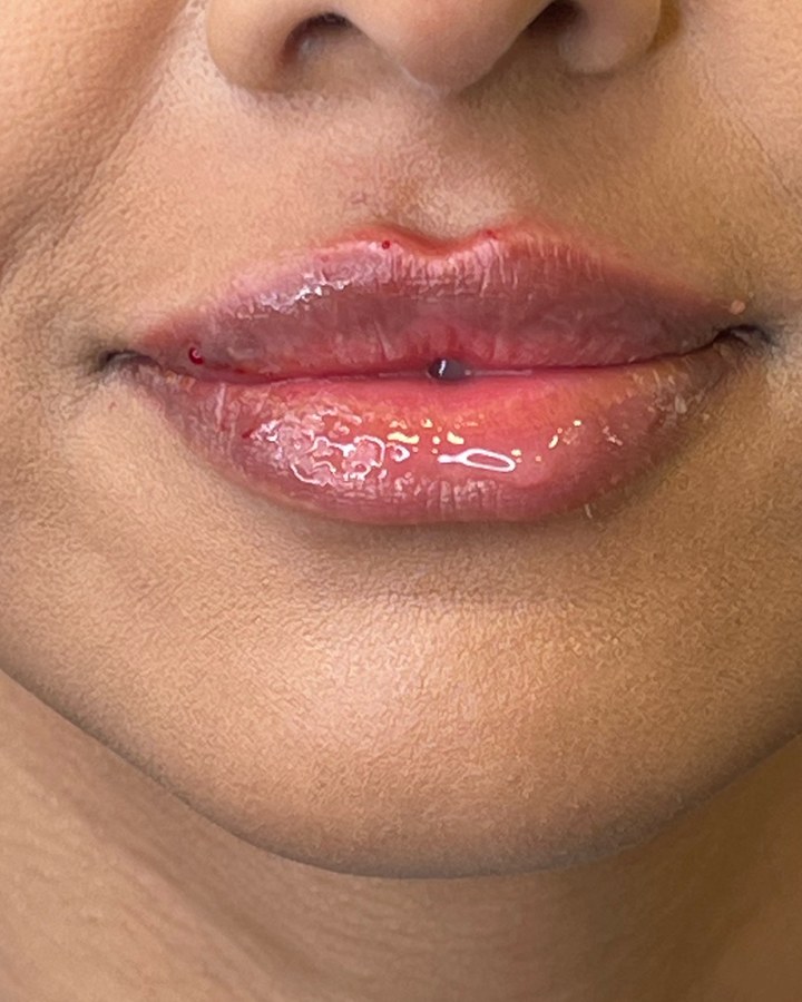Lips, case 10 of 10: after