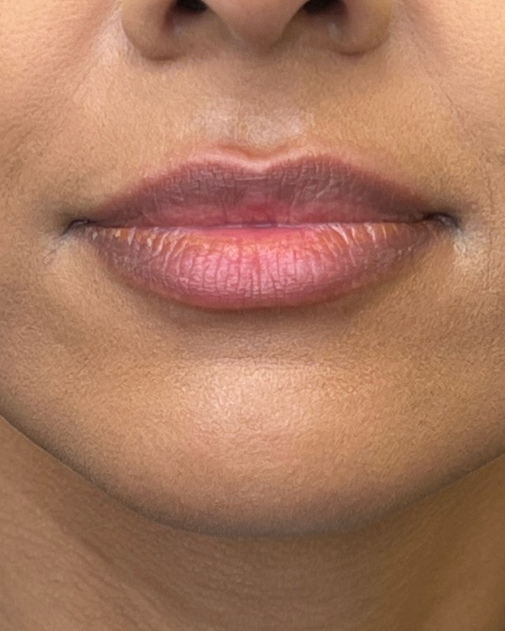Lips, case 10 of 10: before