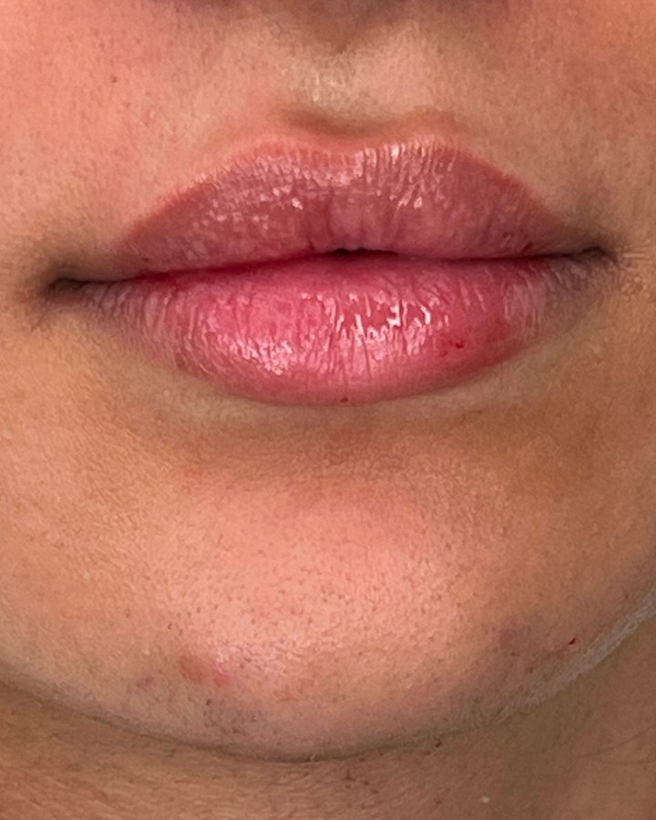 Lips, case 2 of 10: after