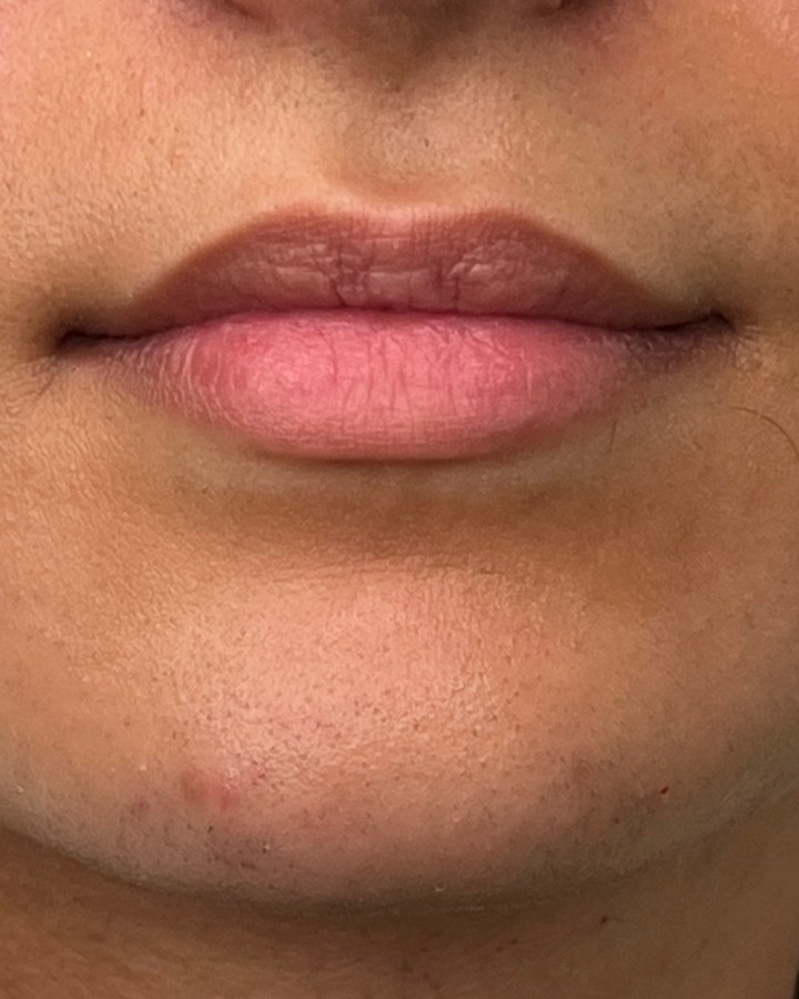 Lips, case 2 of 10: before