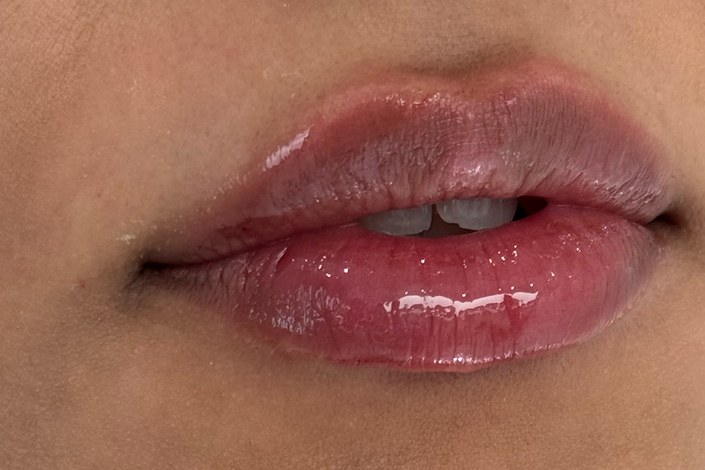 Lips, case 3 of 10: after