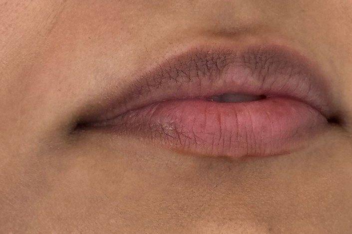 Lips, case 3 of 10: before