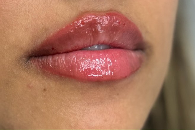 Lips, case 4 of 10: after