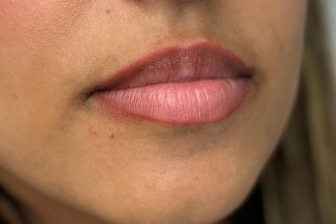 Lips, case 4 of 10: before