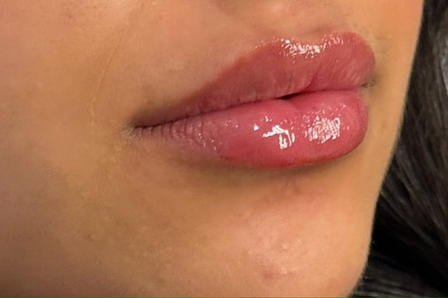 Lips, case 5 of 10: after