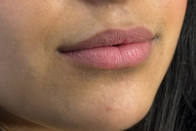 Lips, case 5 of 10: before