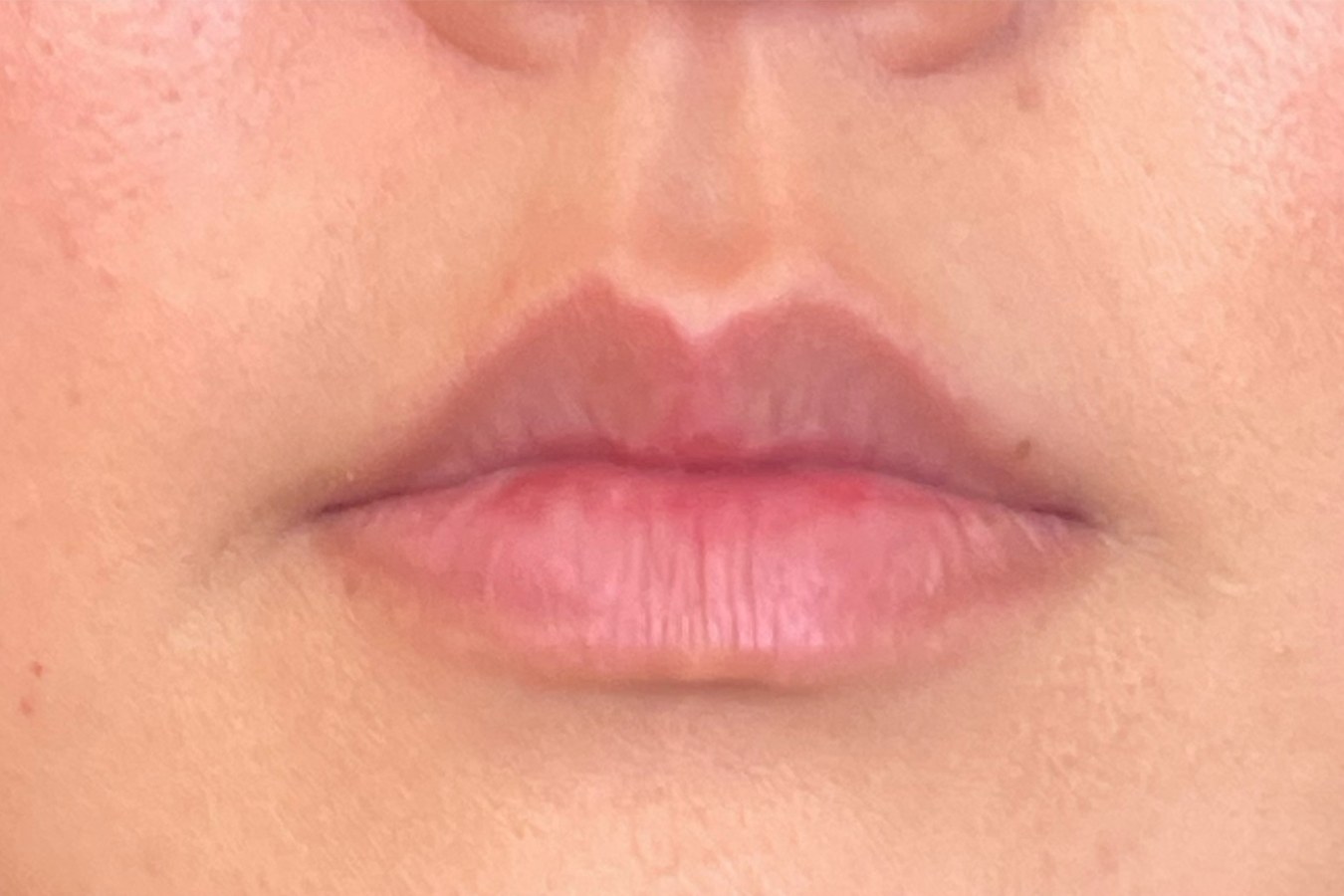 Lips, case 6 of 10: before