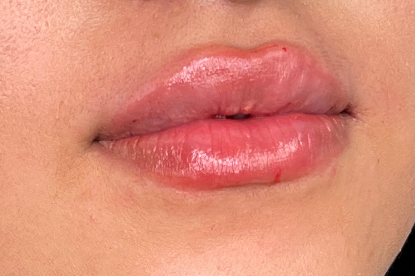 Lips, case 7 of 10: after