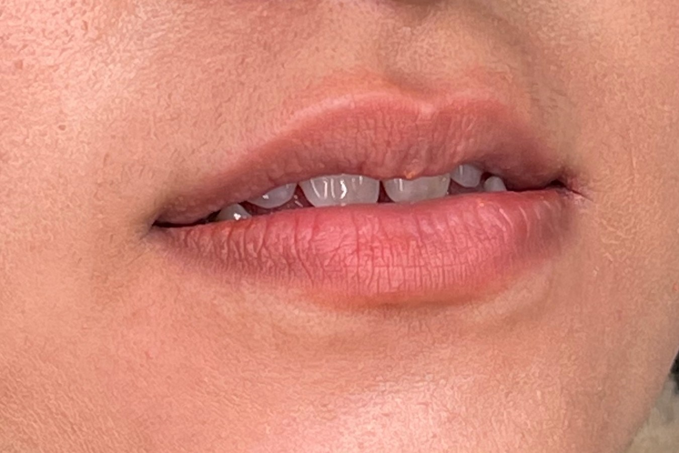 Lips, case 7 of 10: before