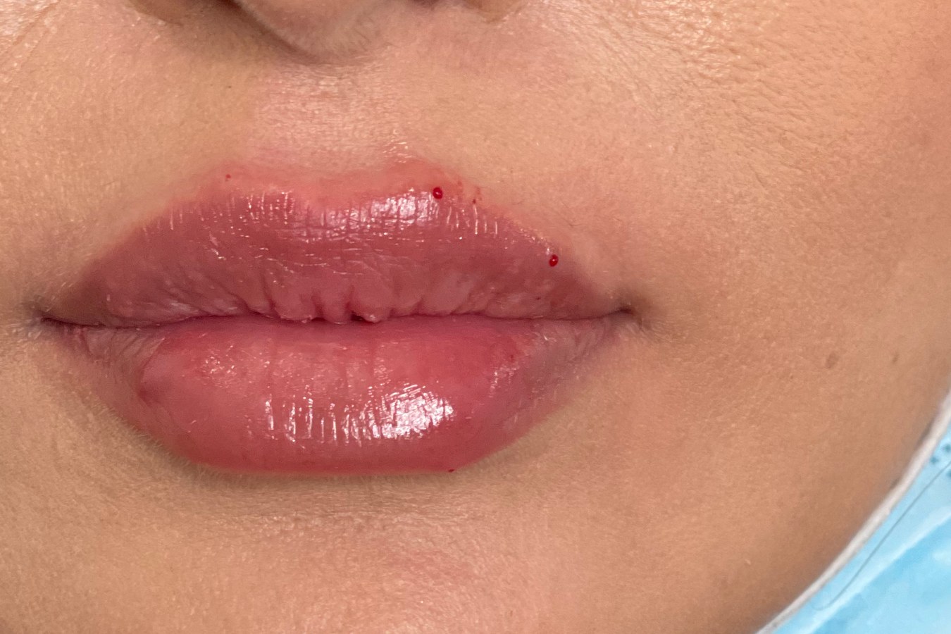 Lips, case 8 of 10: after