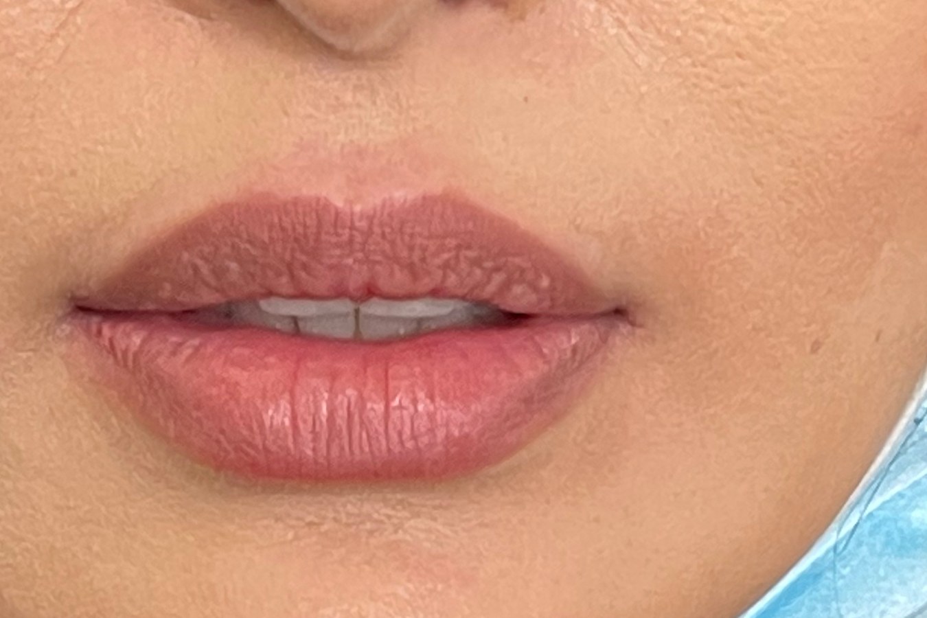 Lips, case 8 of 10: before