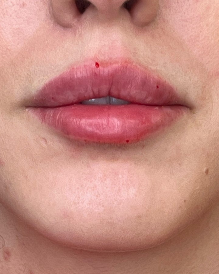 Lips, case 9 of 10: after