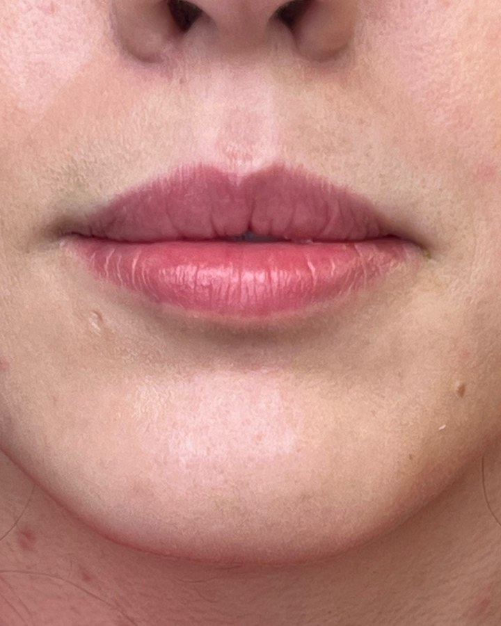 Lips, case 9 of 10: before