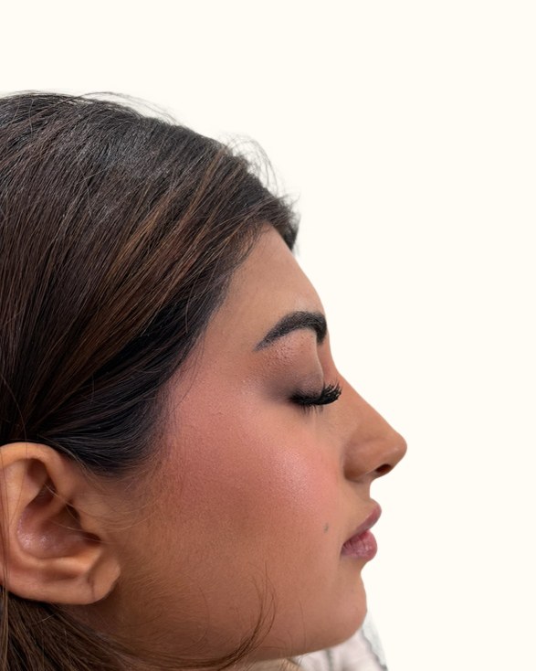 Nose, case 1 of 14: after