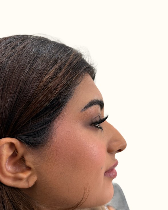 Nose, case 1 of 14: before
