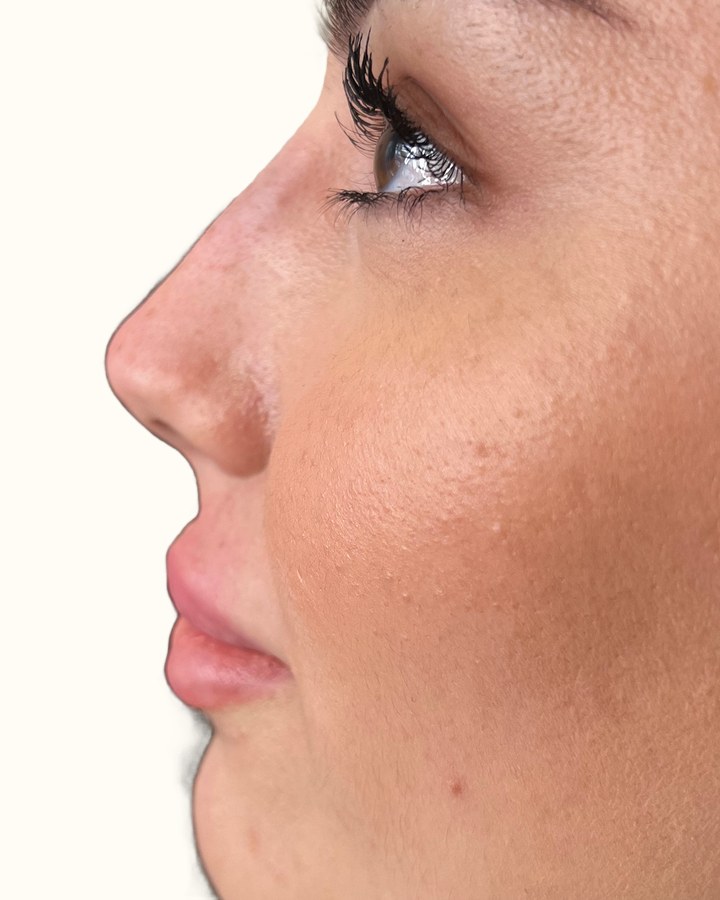Nose, case 10 of 14: after