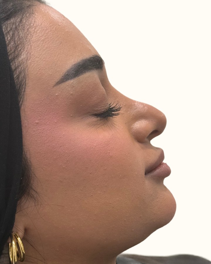 Nose, case 12 of 14: before
