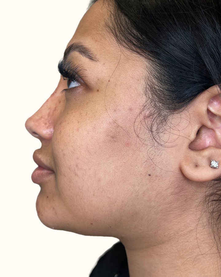 Nose, case 13 of 14: after