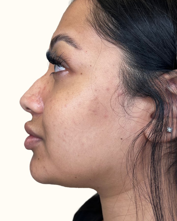 Nose, case 13 of 14: before