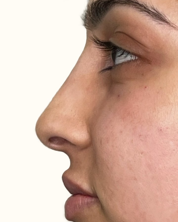 Nose, case 2 of 14: after