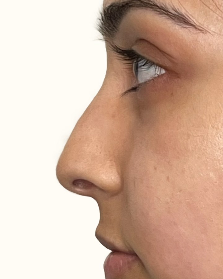 Nose, case 2 of 14: before
