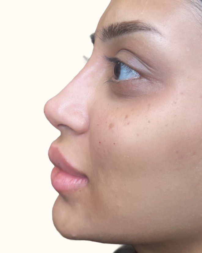 Nose, case 3 of 14: after
