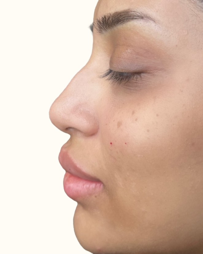 Nose, case 3 of 14: before