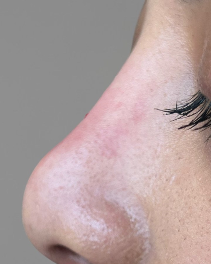Nose, case 4 of 14: after