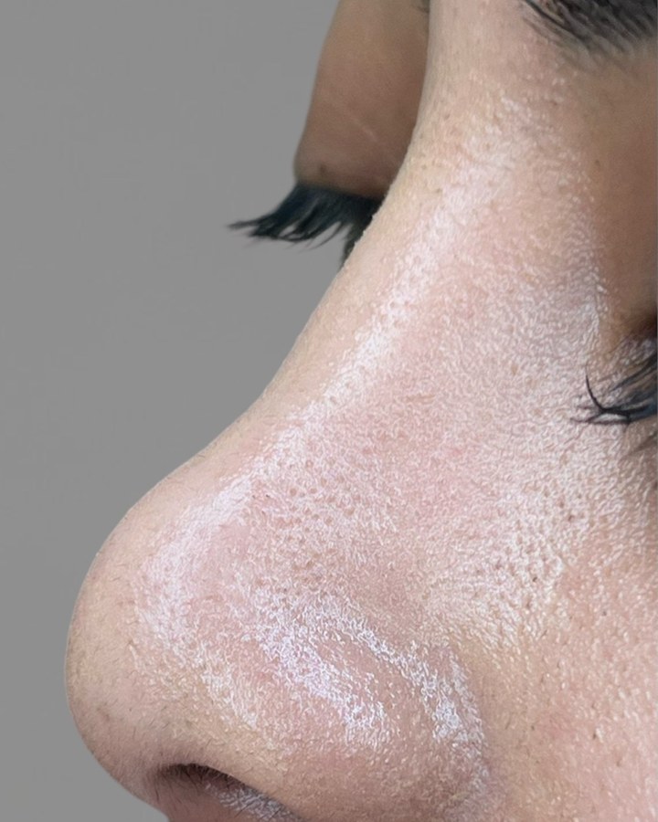 Nose, case 4 of 14: before