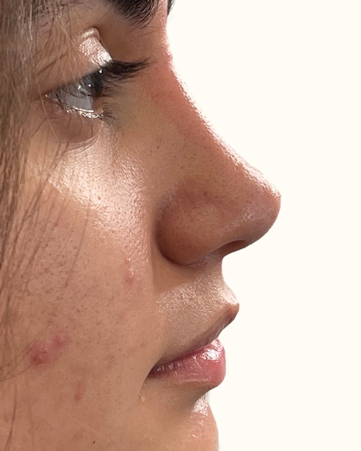 Nose, case 5 of 14: after