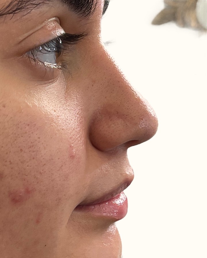 Nose, case 5 of 14: before