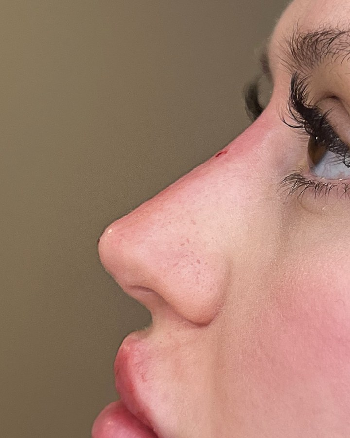 Nose, case 6 of 14: after